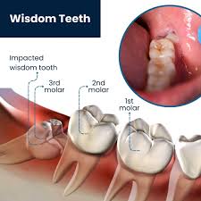 Wisdom Tooth Removal and Extraction