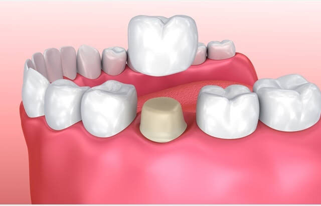 Dental Veneers