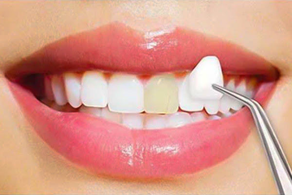 Dental Crowns